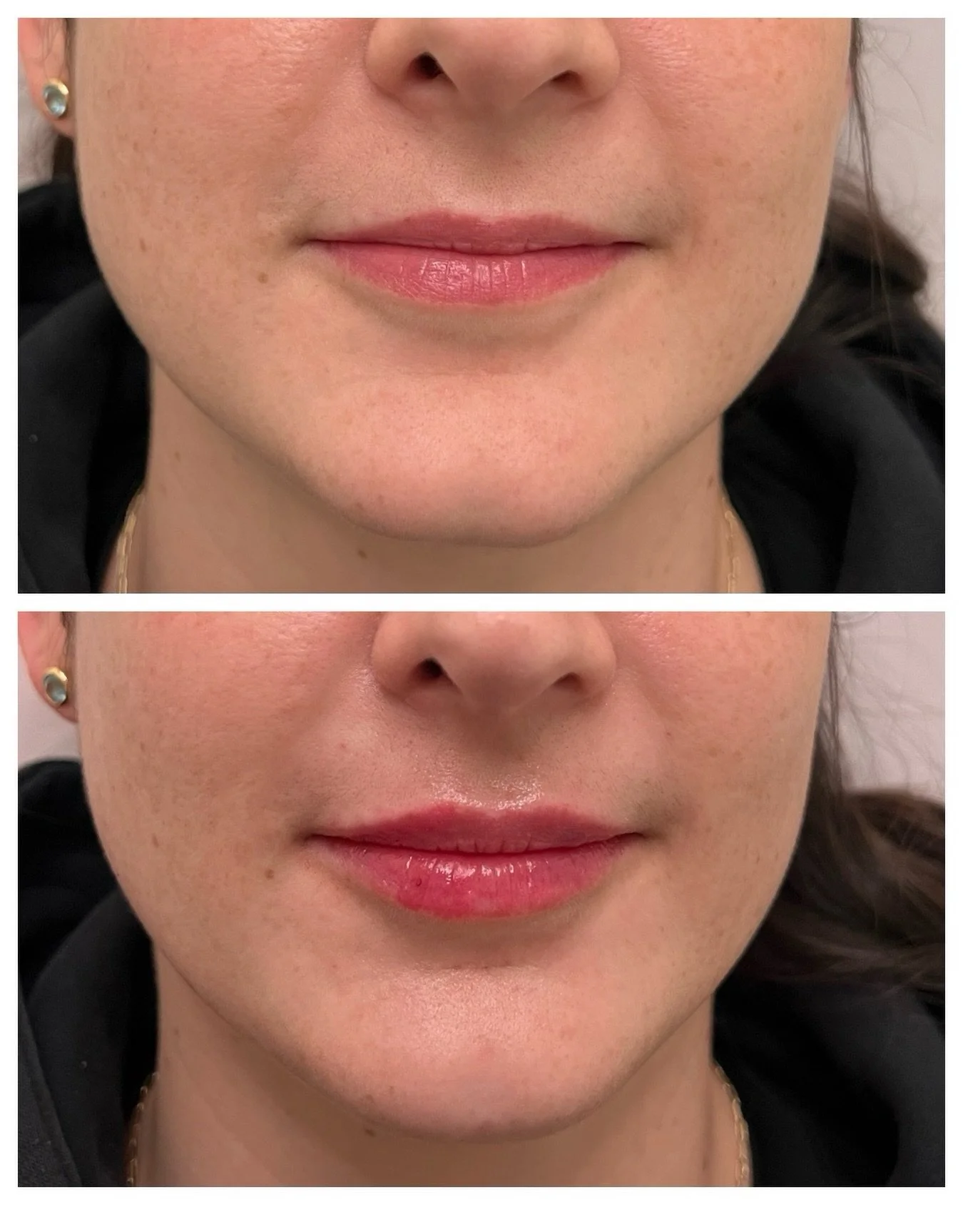 A little definition goes a long way. Chin and Lips for the win for this client. 👏🏻
.
.
.
.
Chin filler is one of the most underrated treatments when it comes to facial contouring&mdash;it enhances your profile, balances facial proportions, and can 