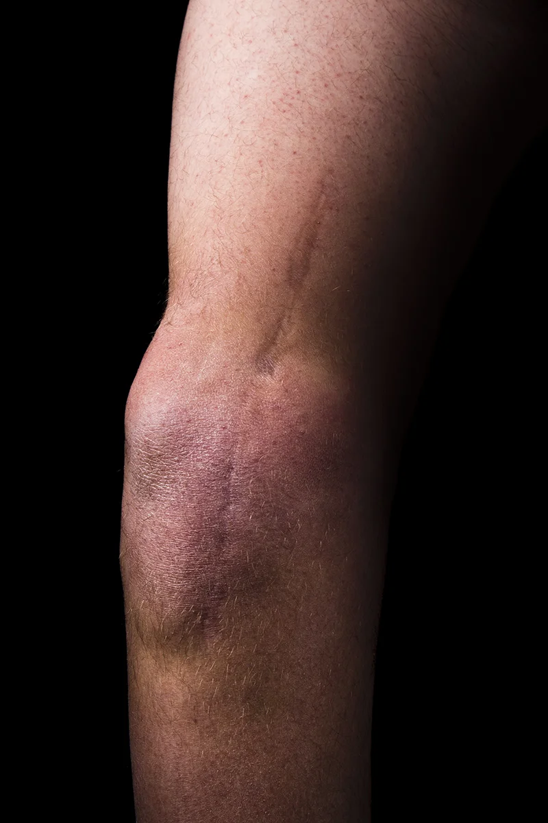 part_of_my_hip_for_my_knee.jpg
