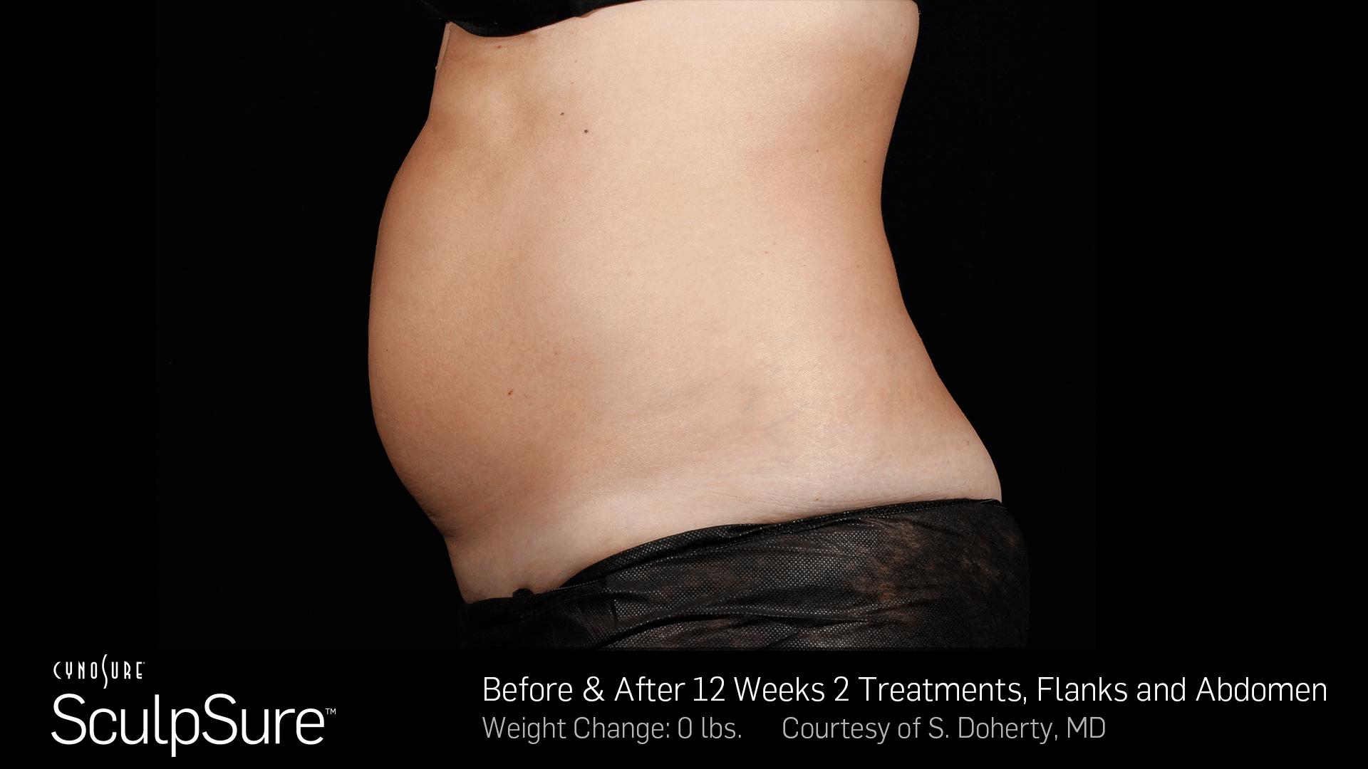 BA__Animated_SculpSure_S_Doherty_Core_2Tx_12weeks_02.1.gif
