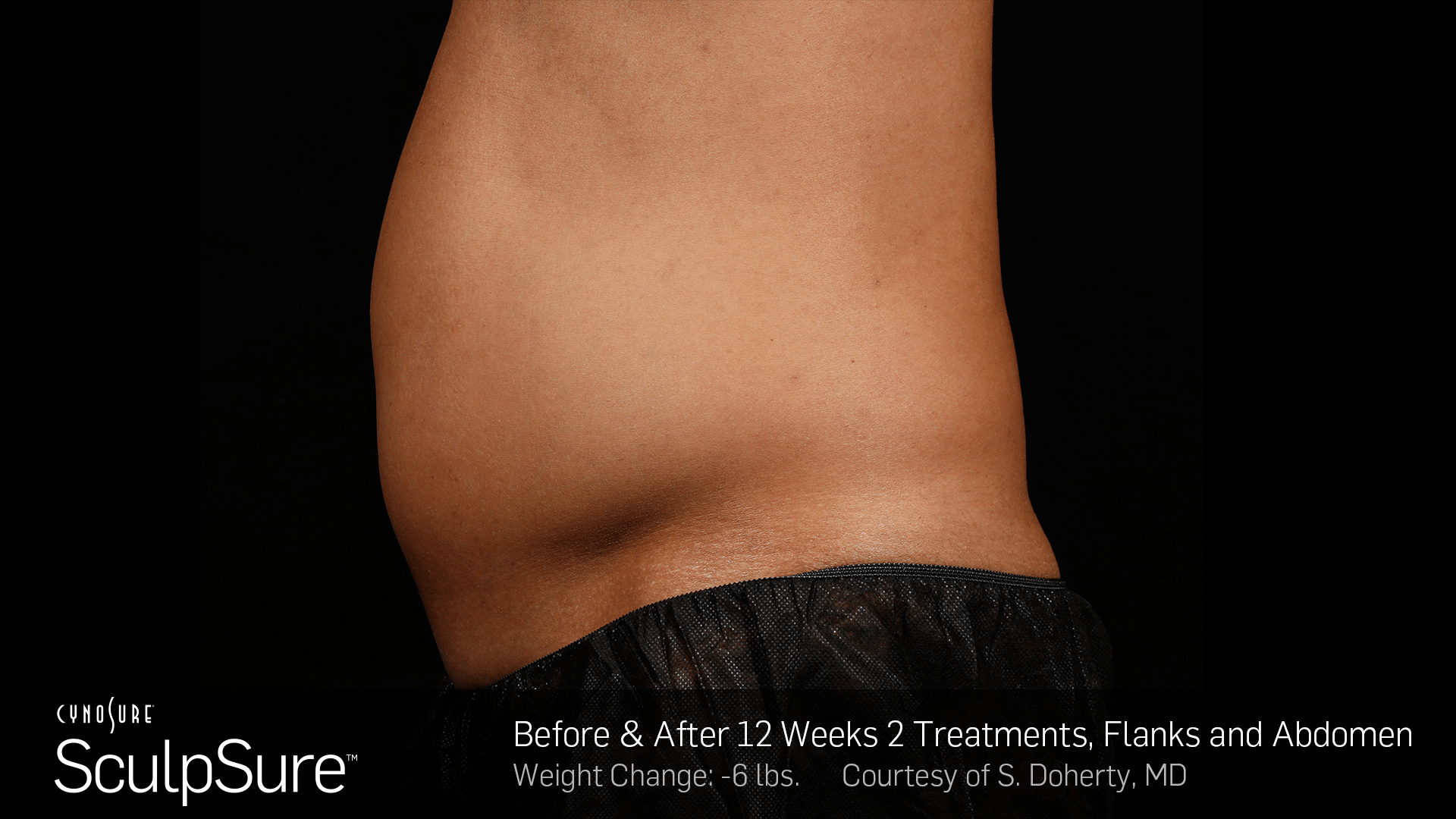 BA_Animated_SculpSure_S_Doherty_Core_2Tx_12Weeks_01.2.gif
