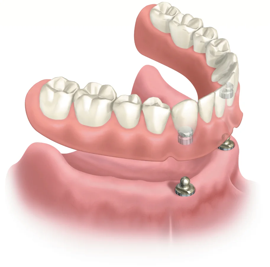 Ball Overdenture2.jpg