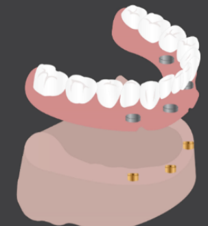 4-Implant retained overdenture