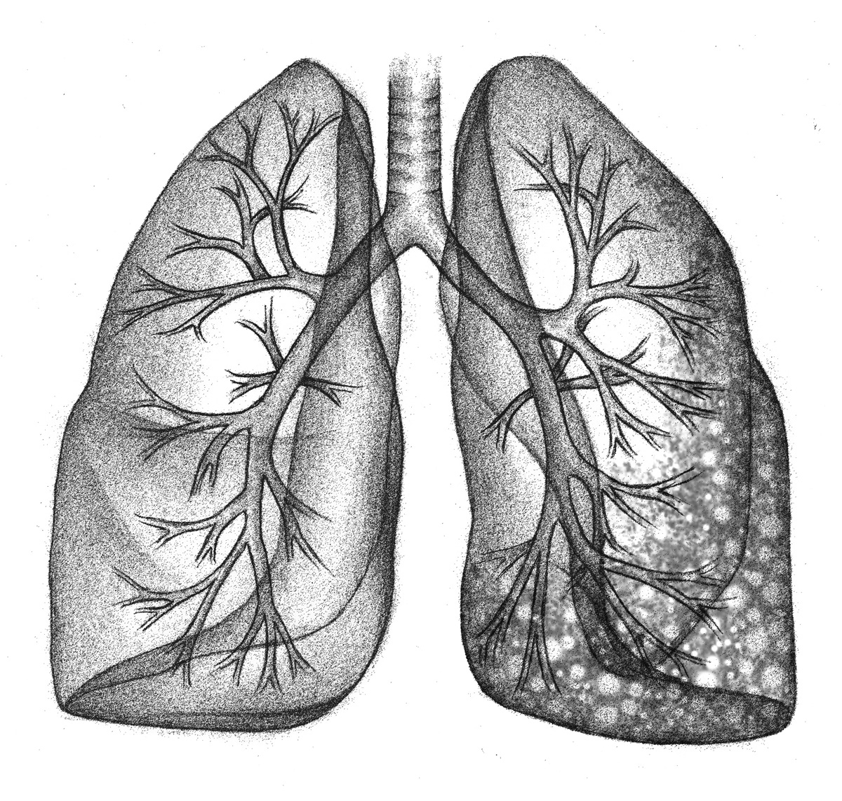  Healthy lung (L), with fibrosis (R)   Graphite, Adobe Photoshop  