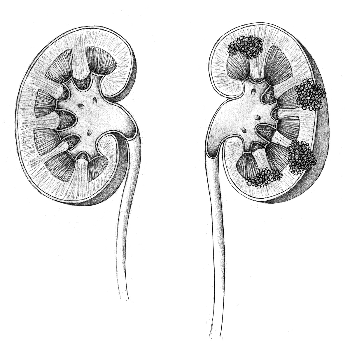  Healthy kidney (L), with tumors (R)   Graphite, Adobe Photoshop  