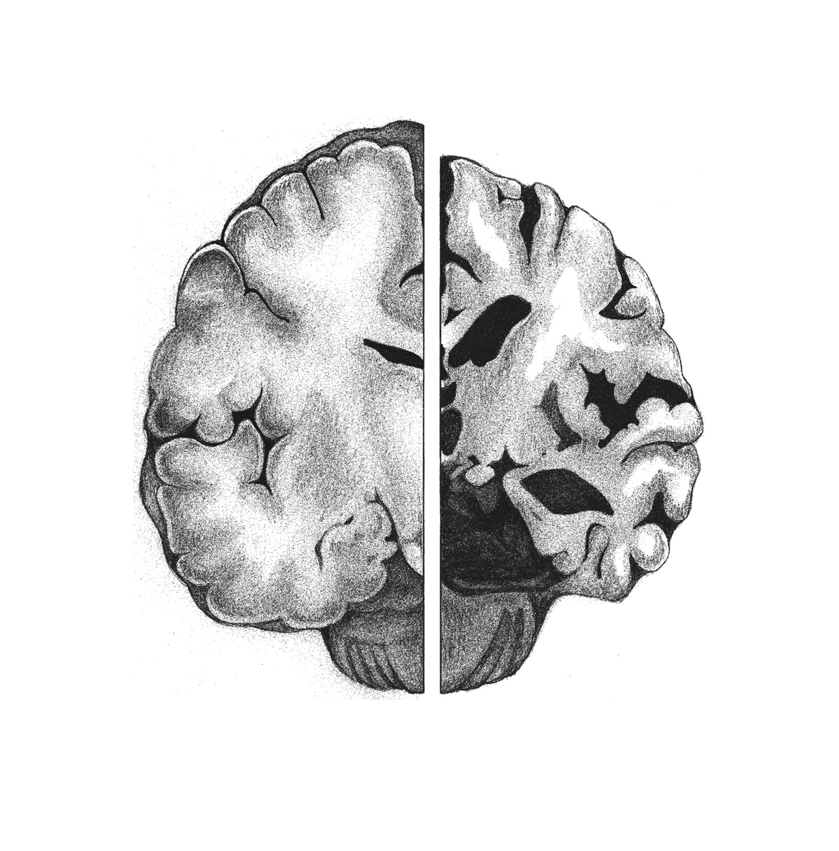  Normal brain (L), afflicted with Alzheimers (R)   Graphite, Adobe Photoshop  