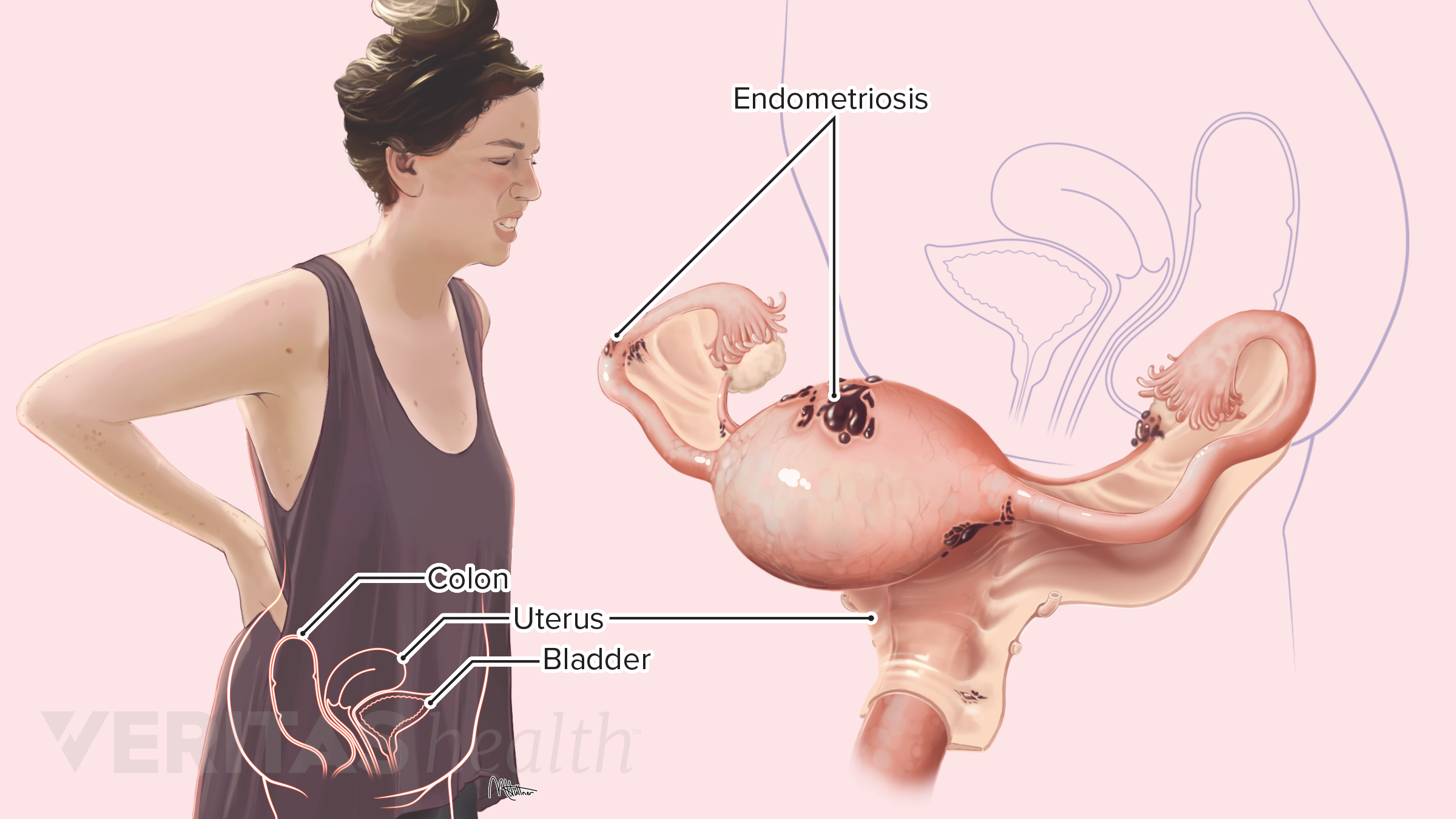 Endometriosis copy.png