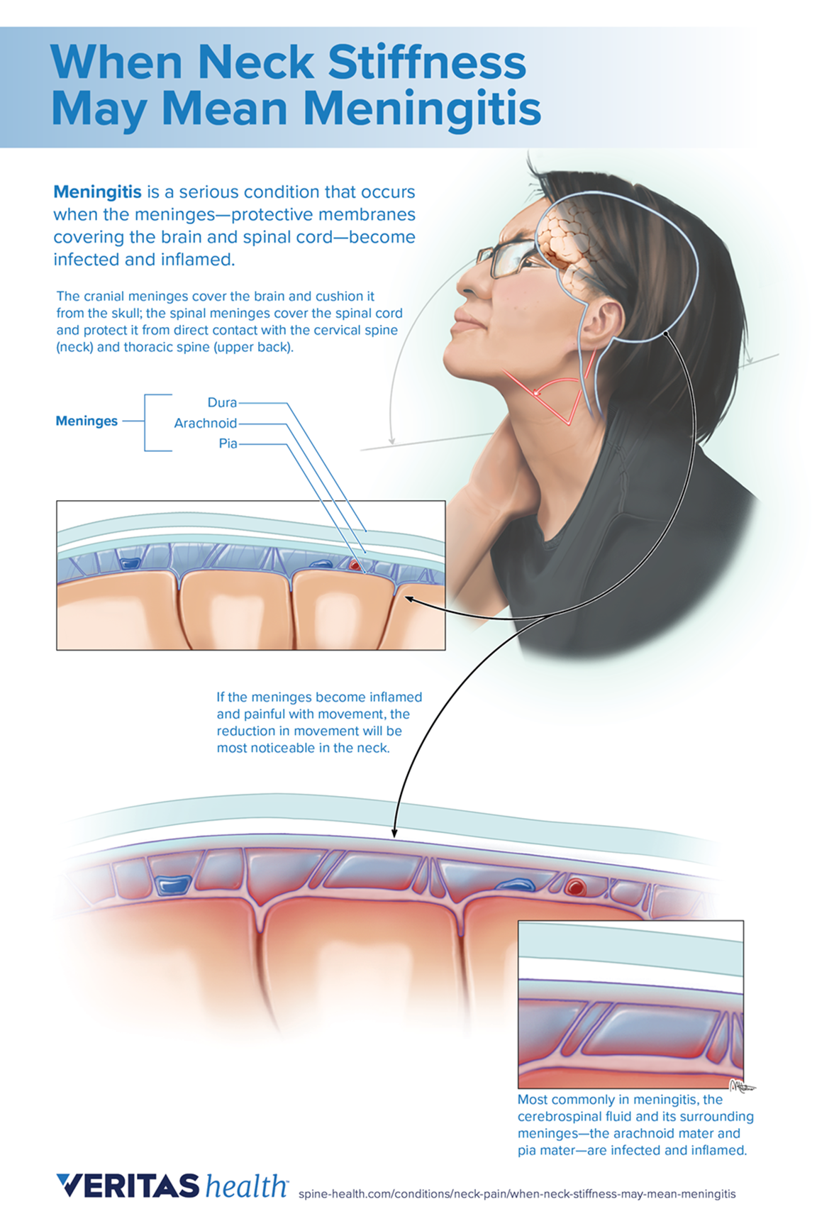 Infographic_Meningitis.png