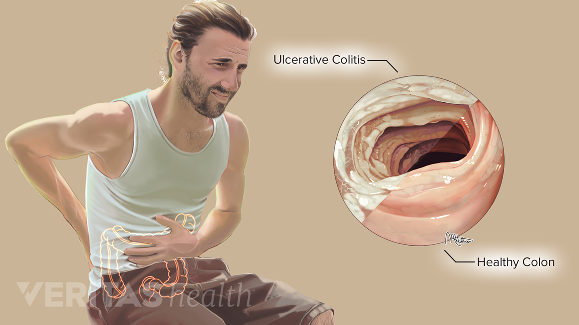 Ulcerative-Colitis copy.png