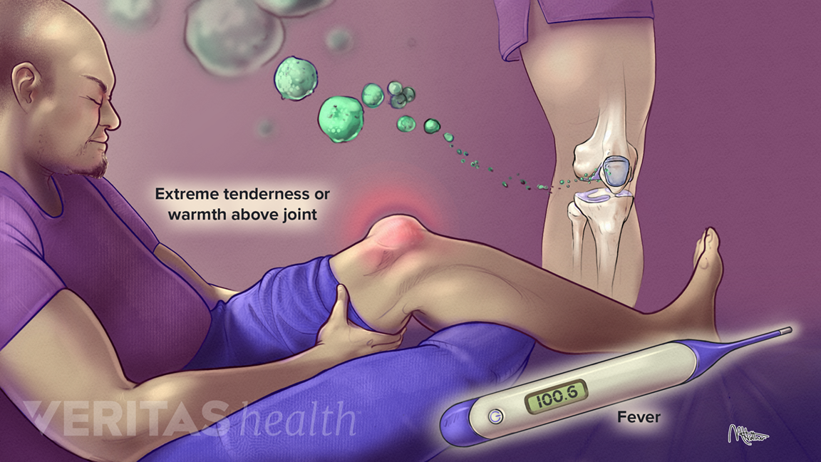 Septic Bursitis.png
