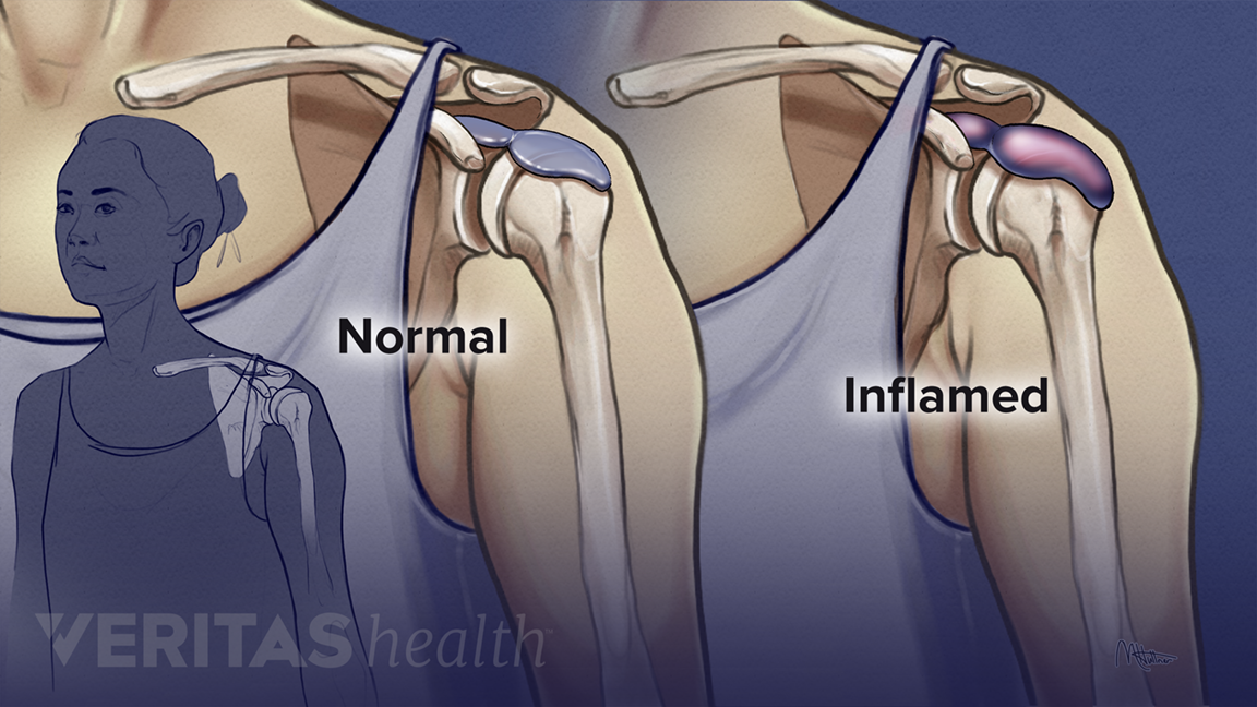 VA344_SubacromialBursitis.png