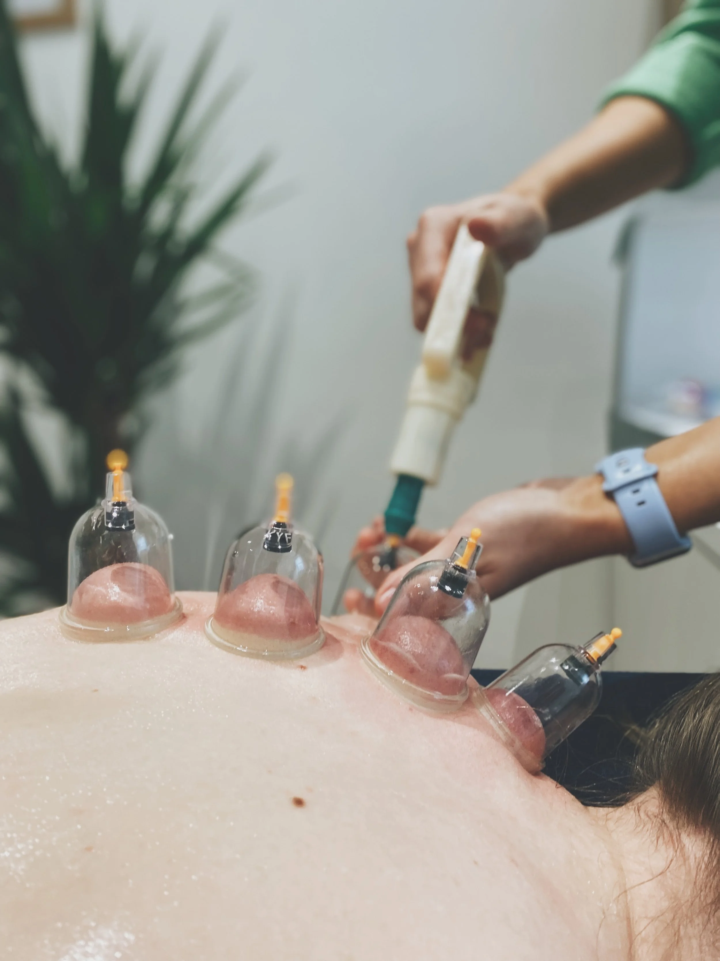 Cupping Therapy At TPP