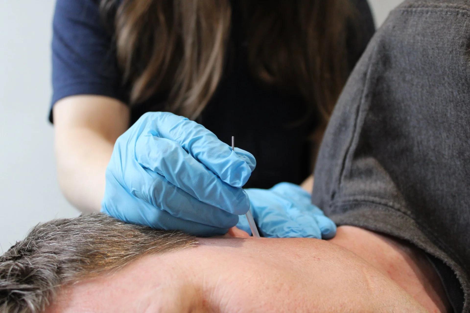 The Benefits of Dry Needling For Jaw Pain