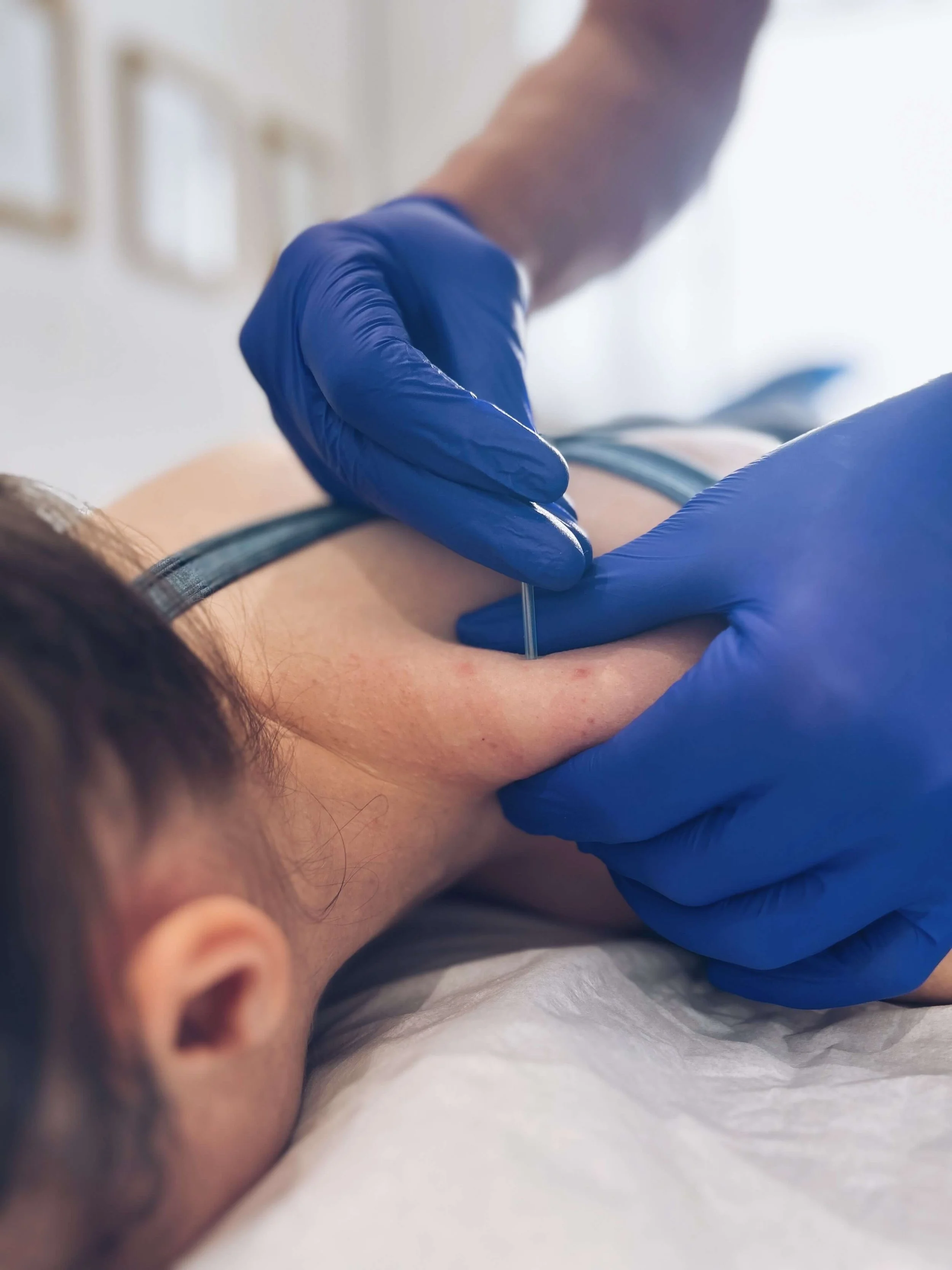 The Benefits of Dry Needling For Neck Pain