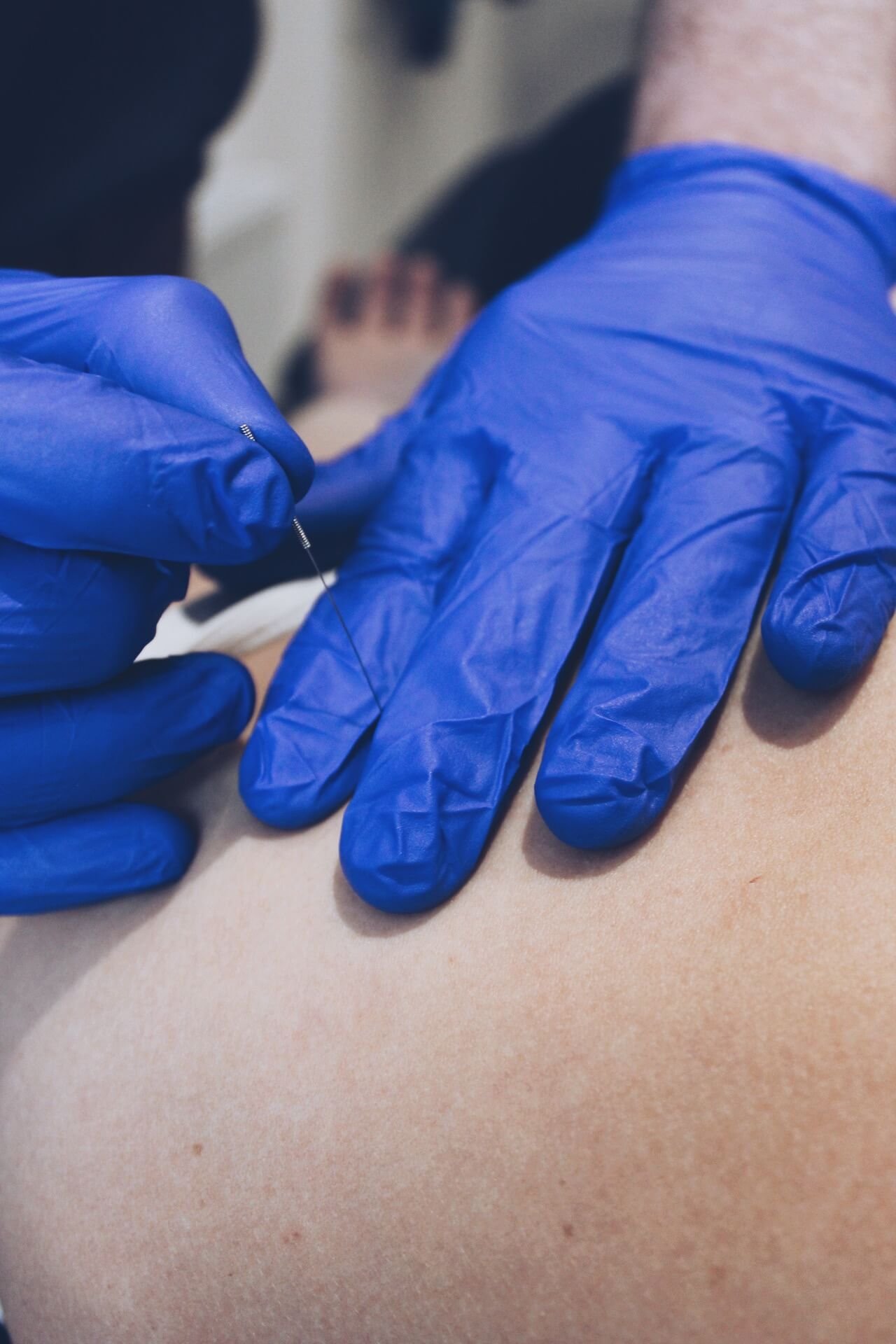 Physiotherapy and Dry Needling for Rotator Cuff Injuries: Effective Shoulder Pain Relief