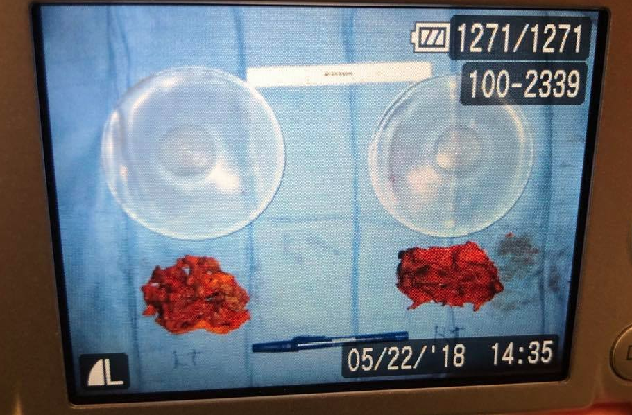 My 550 CC Silicone casing and filled implant with capsules peeled off.