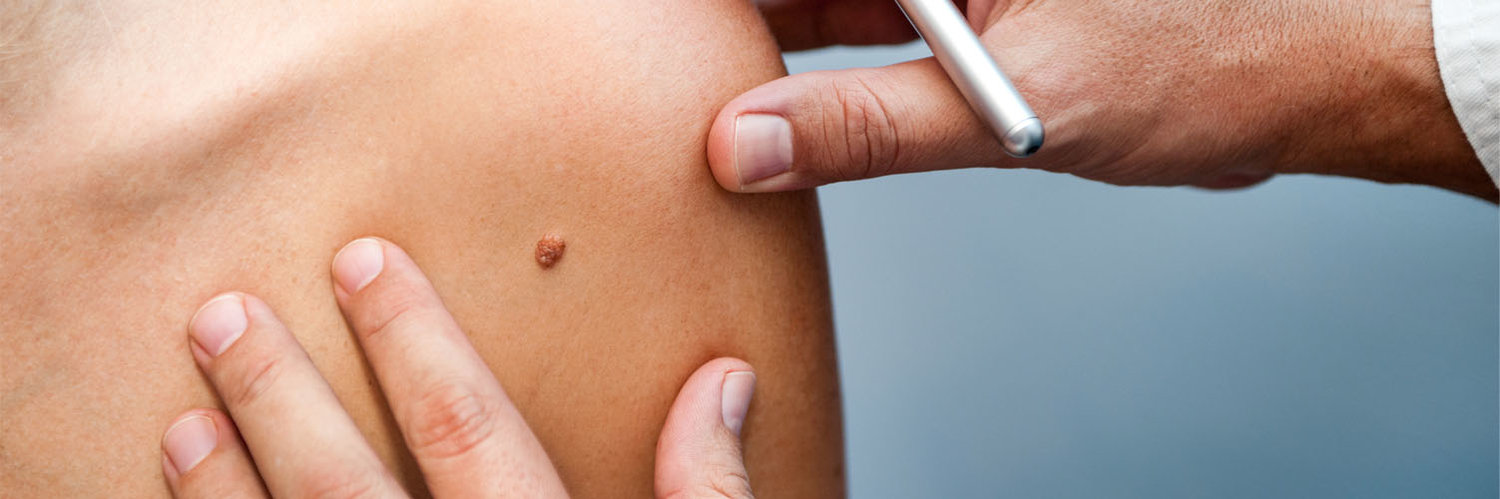 Hpv skin moles, Warts on skin during pregnancy
