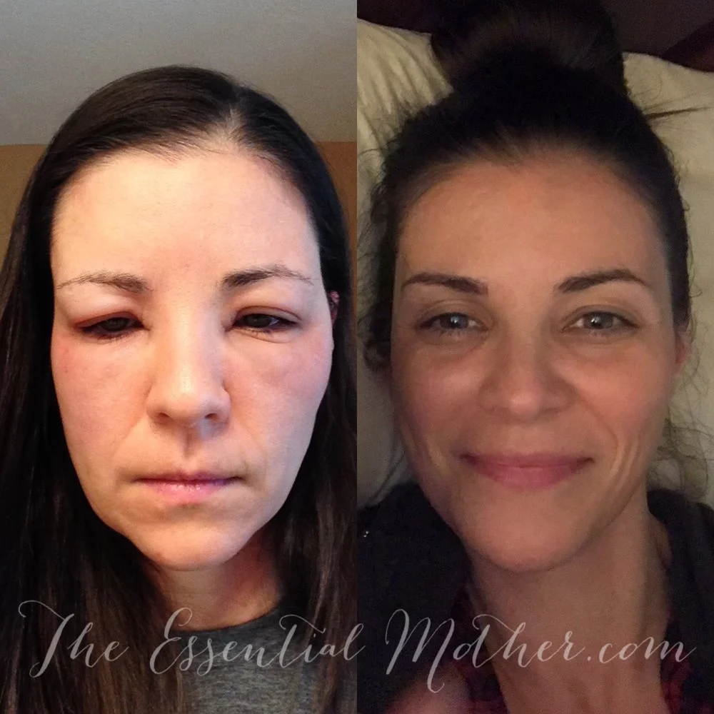 Before and after Lupus.jpg