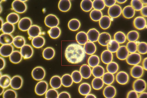 hypersegmented neutrophil highlighted.jpg