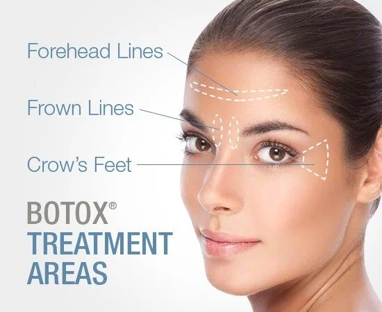 botox-treatment-areas.jpg