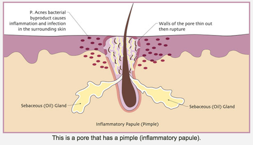 Non Inflamed What is Acne? – Pure Dermal Care