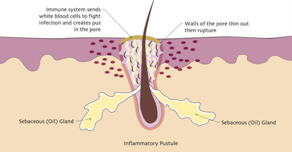 Pimples, Pustules & Cysts — Pure Dermal Care
