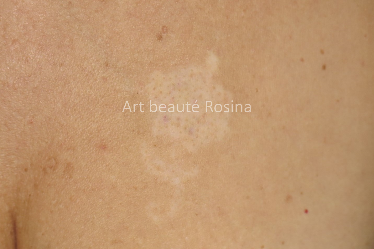 Dépigmentation des suites d'un détatouage au laser d'un tattoo décoratif