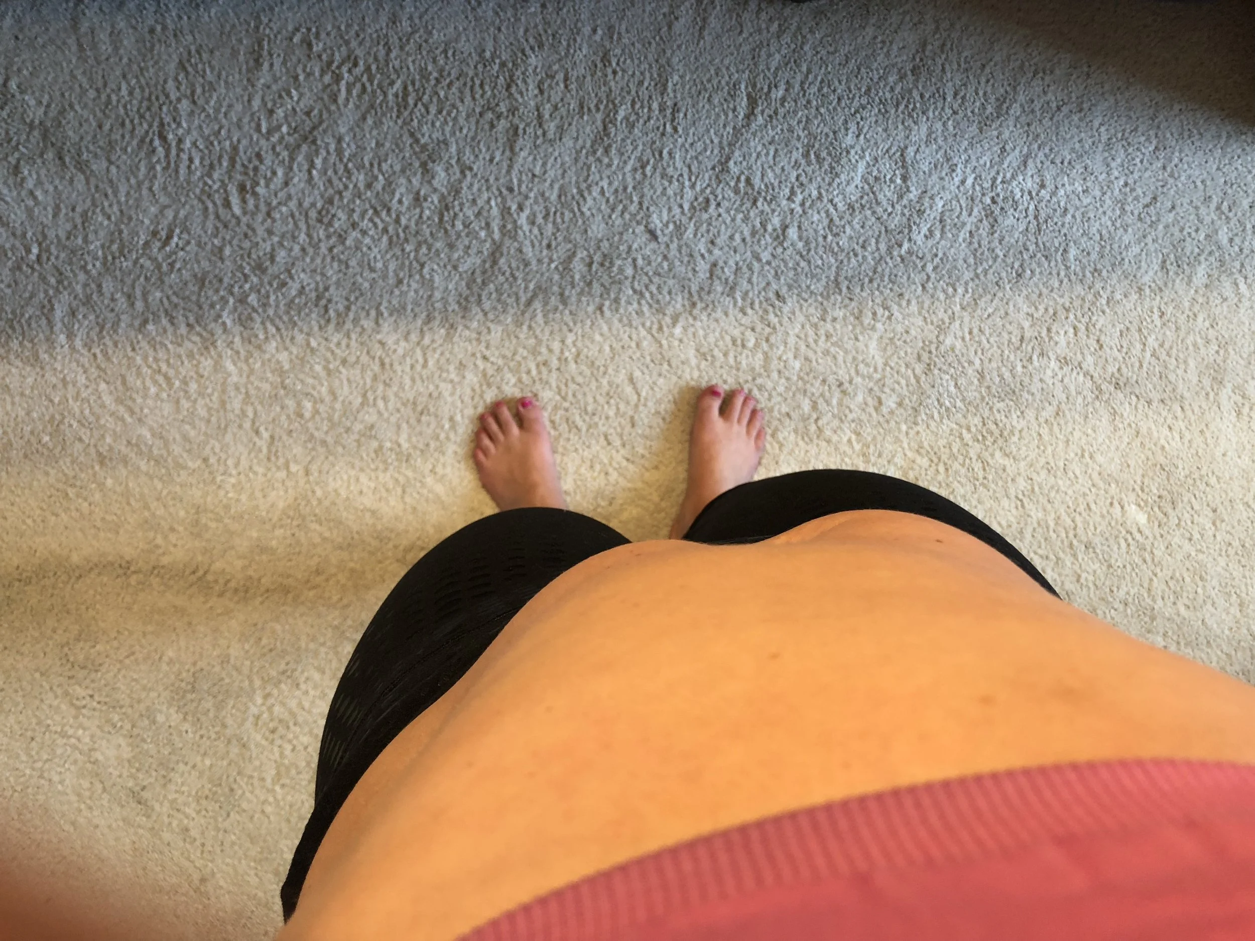 Before I went to the ER the third time. My stomach looked like this every time I had this issue and you can see how the left side is totally sticking out. The intestines were completely blocked off so nothing was getting through. 