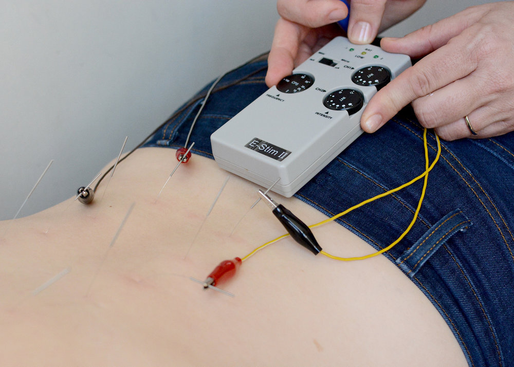 South Philly Community Acupuncture-Electro-Stimulation