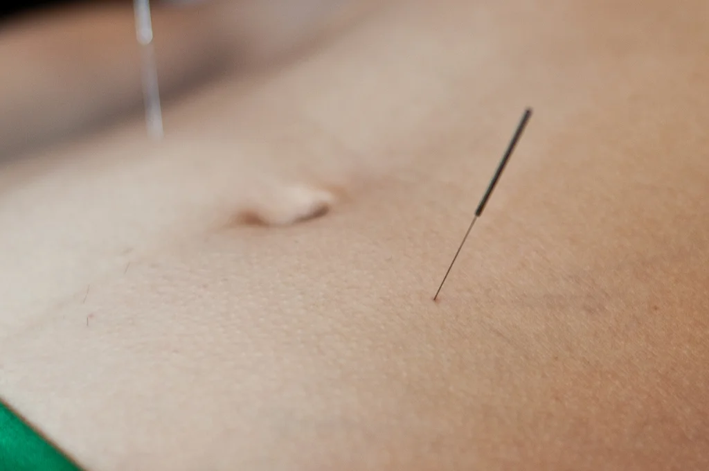 Fertility Acupuncture.jpg