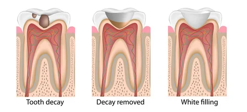 Dental Fillings