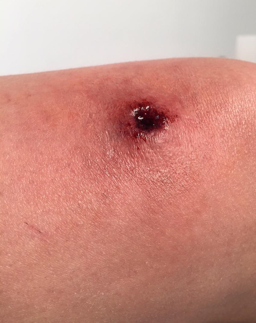 Bullet wound. Application/Makeup by Hannah Sherer for PTM Merchandise. Sculpt by Saeko Yamazaki for PTM.