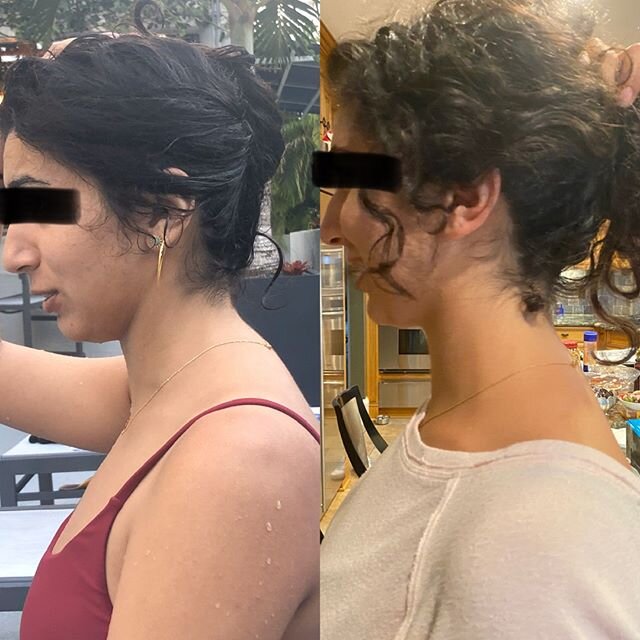 Dowager&rsquo;s Hump 🐫
.
Look at the miracles that my client had worked out in just a few weeks! A lifetime of forward head posture and rounded upper back led to the transition point between this patient&rsquo;s upper back and lower neck to look lik