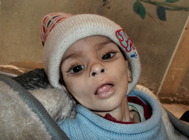  Second atatchment:&nbsp;Israa al-Masri, a young boy who later died of hunger-related illness, on Jan. 11, 2014 in a besieged neighborhood in Damascus. 