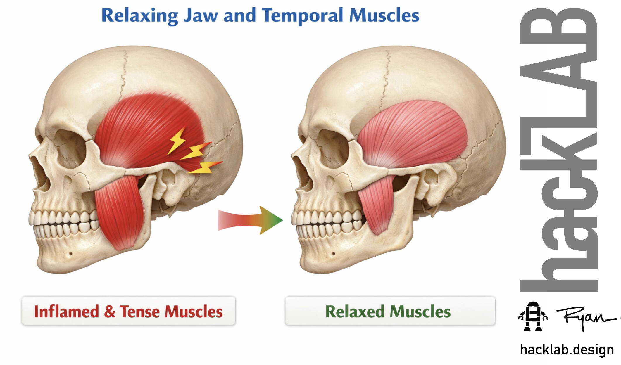 How long does it take to calm facial muscles to lower Tinnitus volume after Bruxism and Clenching Stops