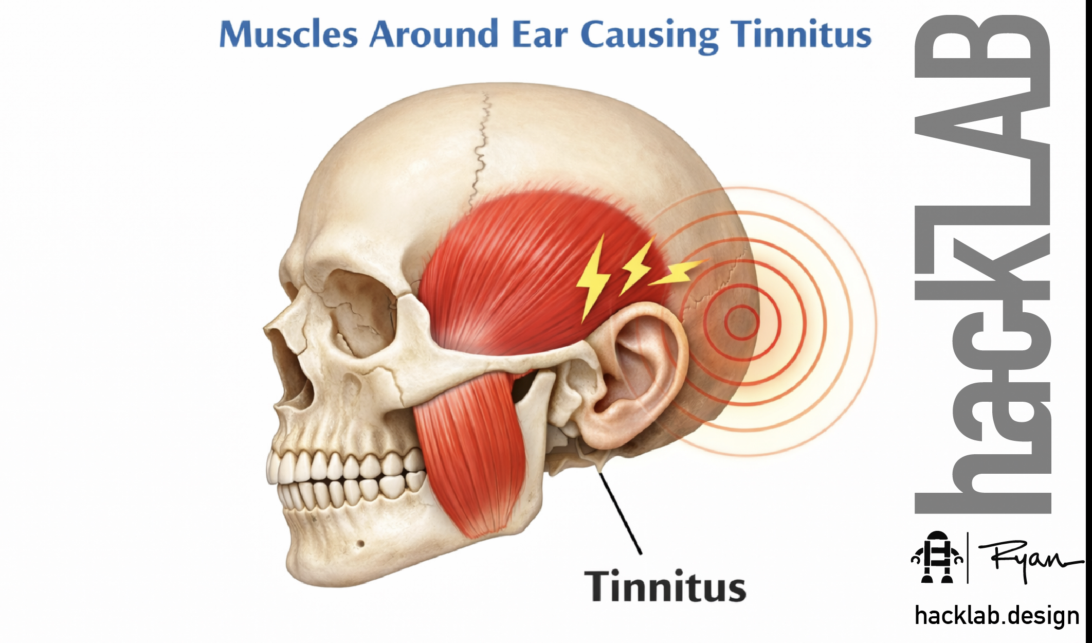 Can stopping Clenching and Bruxism stop or lower Tinnitus?