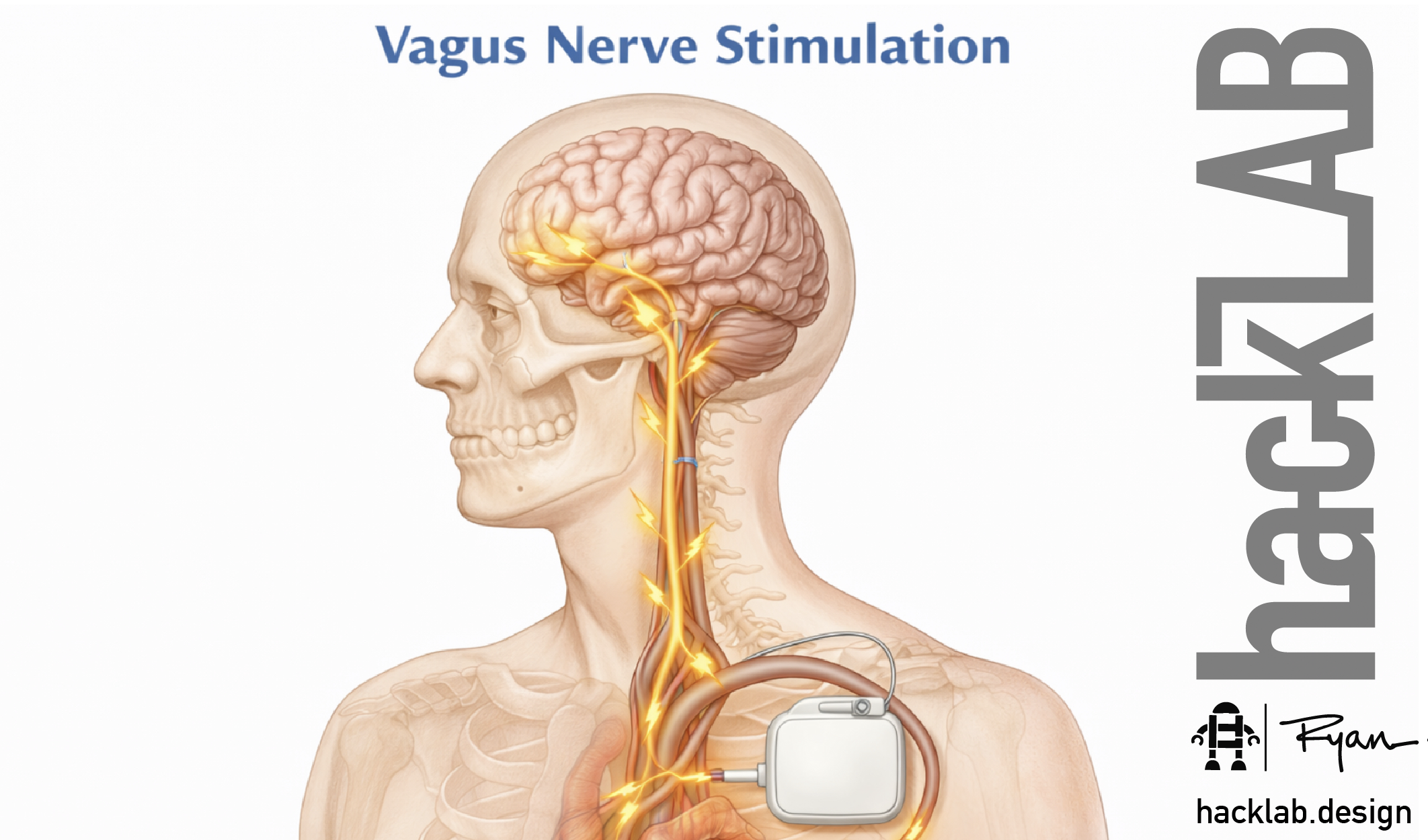 DIY Transcutaneous Vagus Nerve Stimulator for Tinnitus