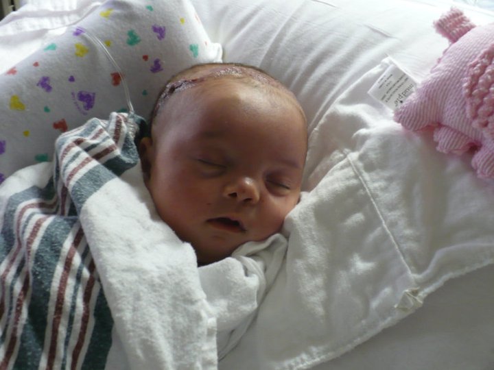 Maddy three days after her surgery