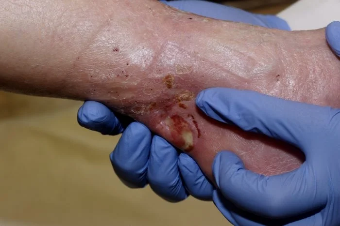 We do wound care