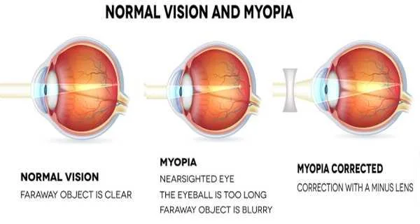 Myopia image.jpg