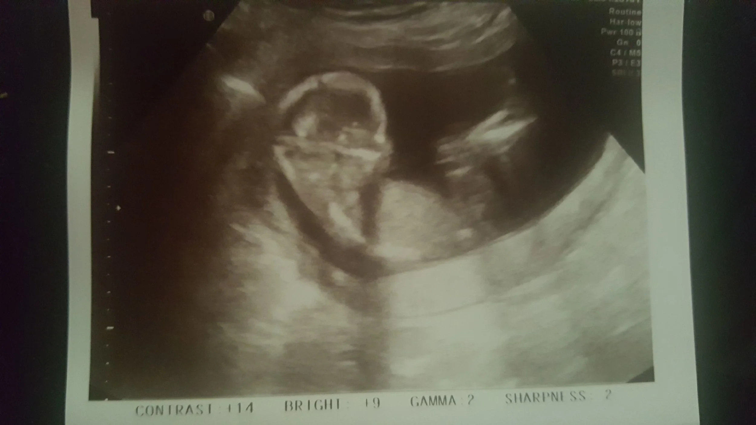Our Baby - Week 14 Ultrasound