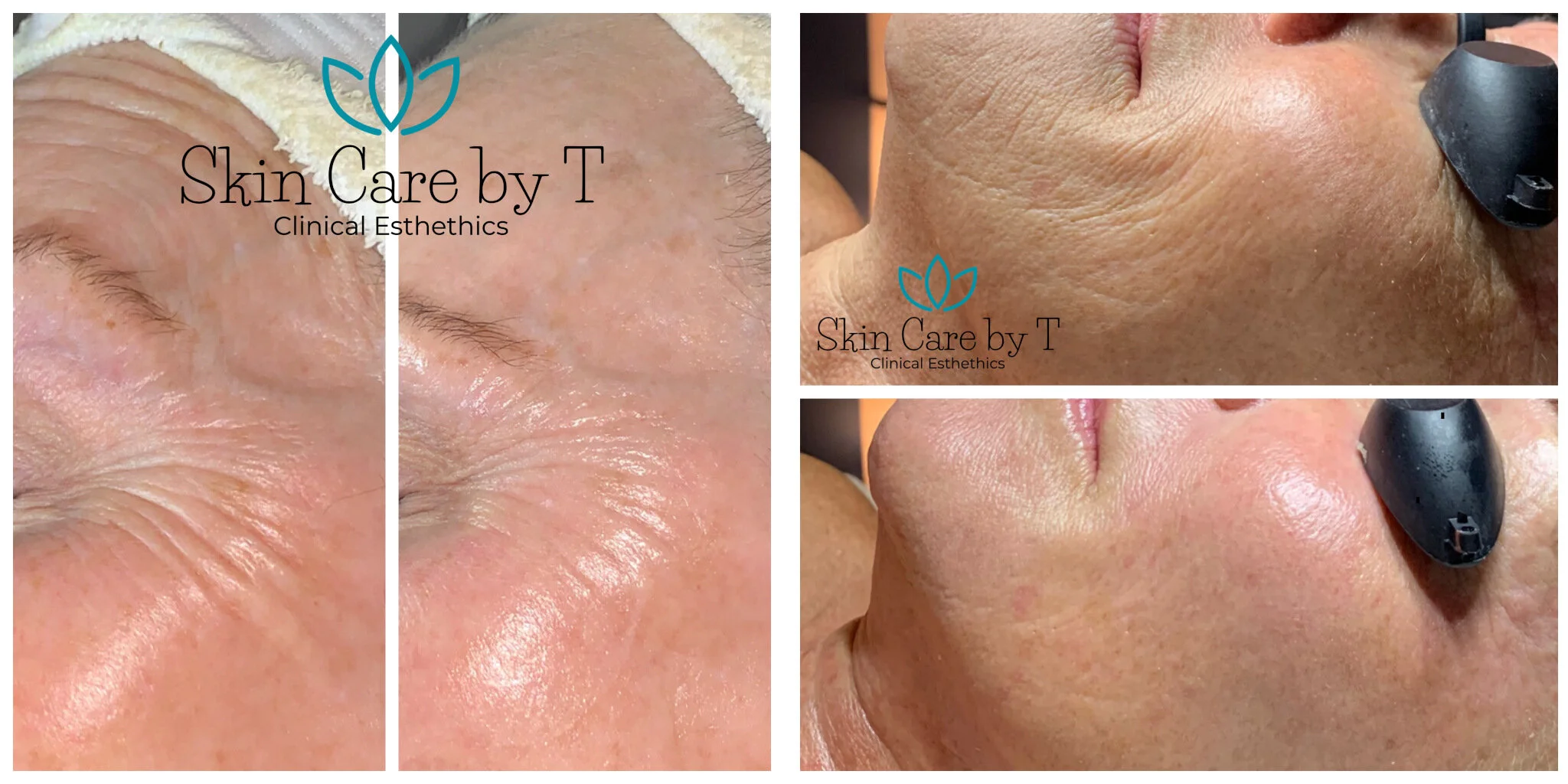 sculplla treatment near me