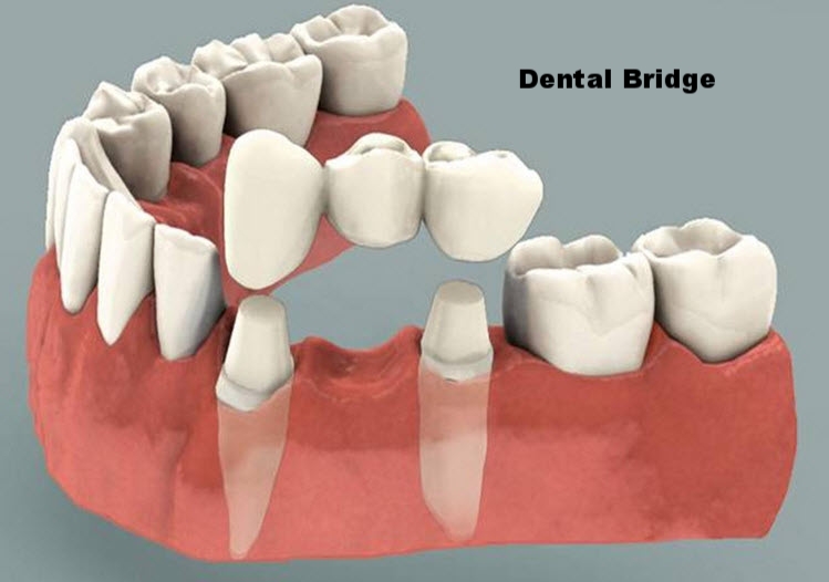 dental bridge.jpg