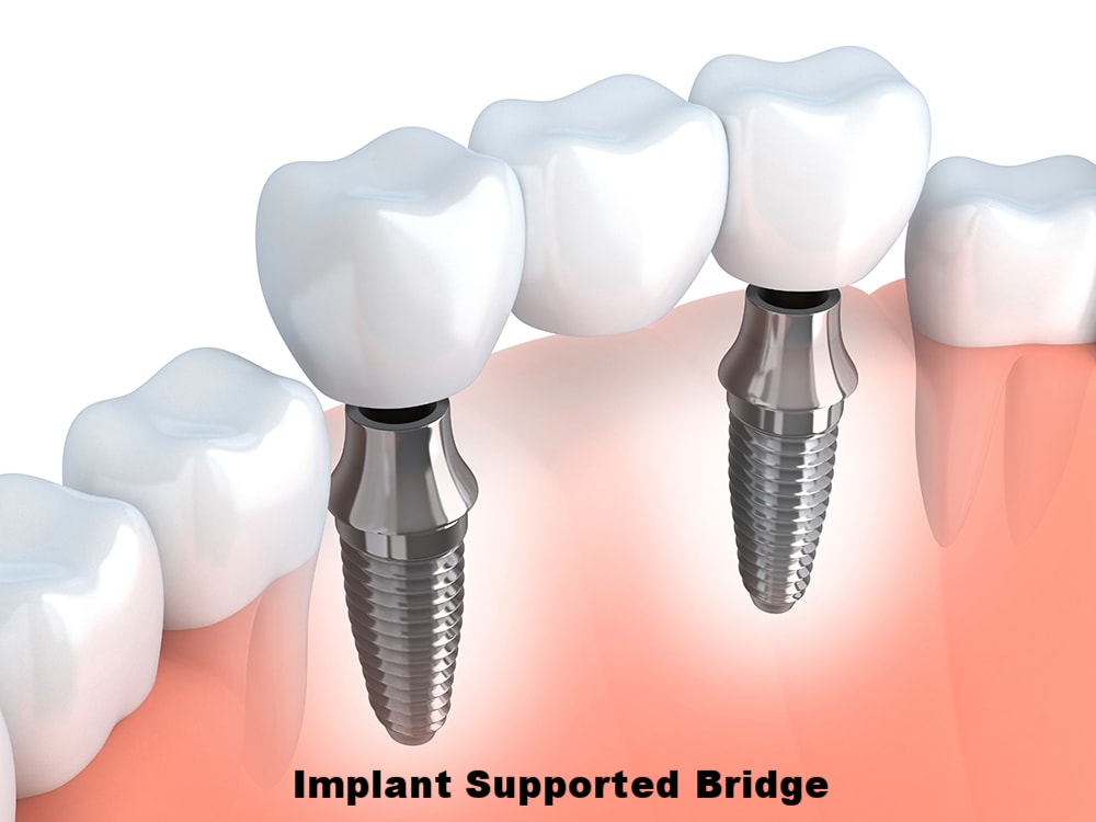 implant bridge.jpg