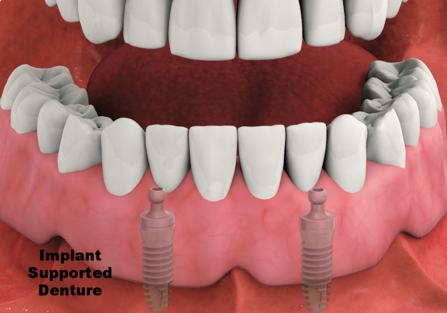 Implant supported denture.jpg