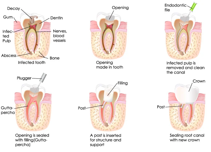 Root Canal Procedure.jpg