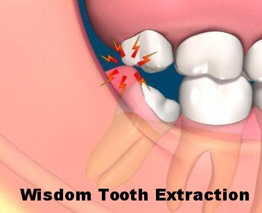 wisdom teeth removal.jpg