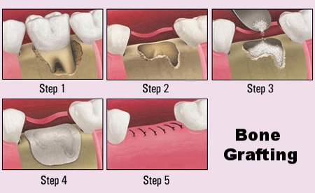 bone grafting.jpg