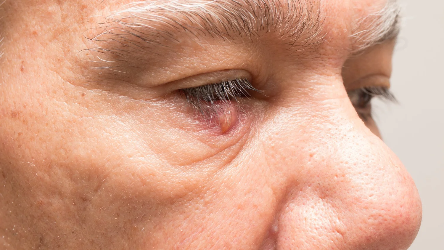 Eye Stye Causes, Symptoms & Treatments Eye Concepts