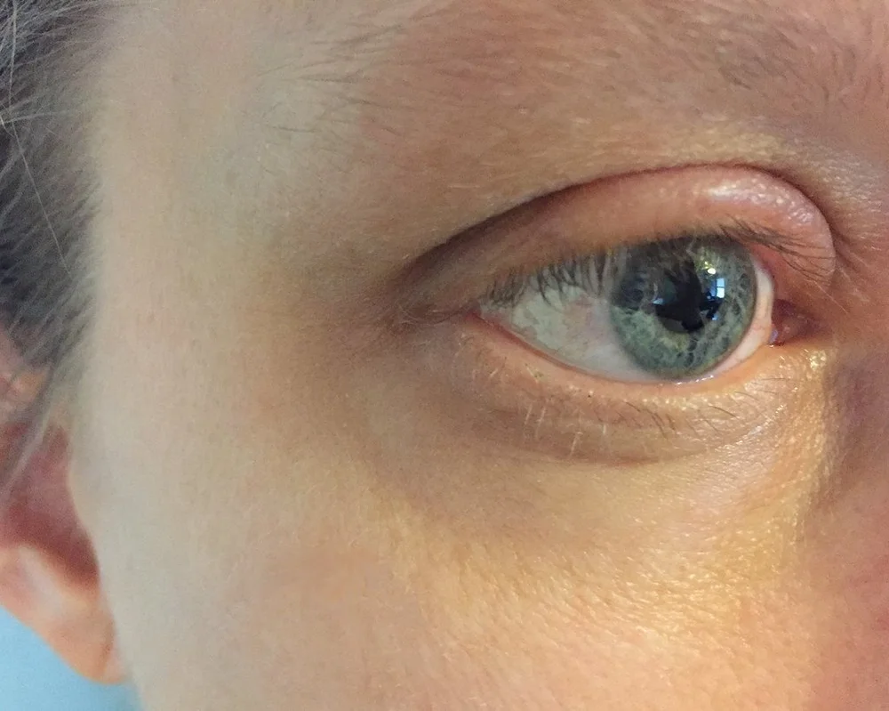 Swollen Eyelid Causes Symptoms And Treatment Eye Concepts Swollen eyelid causes symptoms and treatment eye concepts