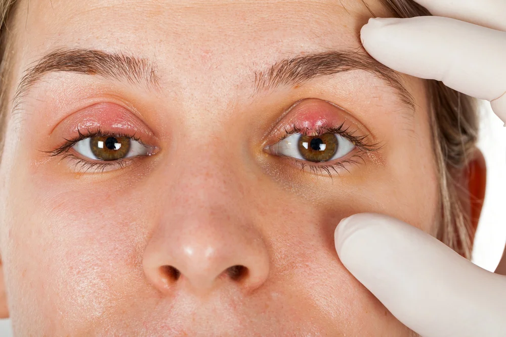 Eye Stye Causes, Symptoms & Treatments Eye Concepts